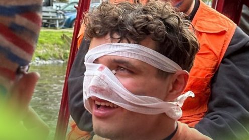 New Lando Norris picture reveals true extent of facial ‘injury’ from Amsterdam party