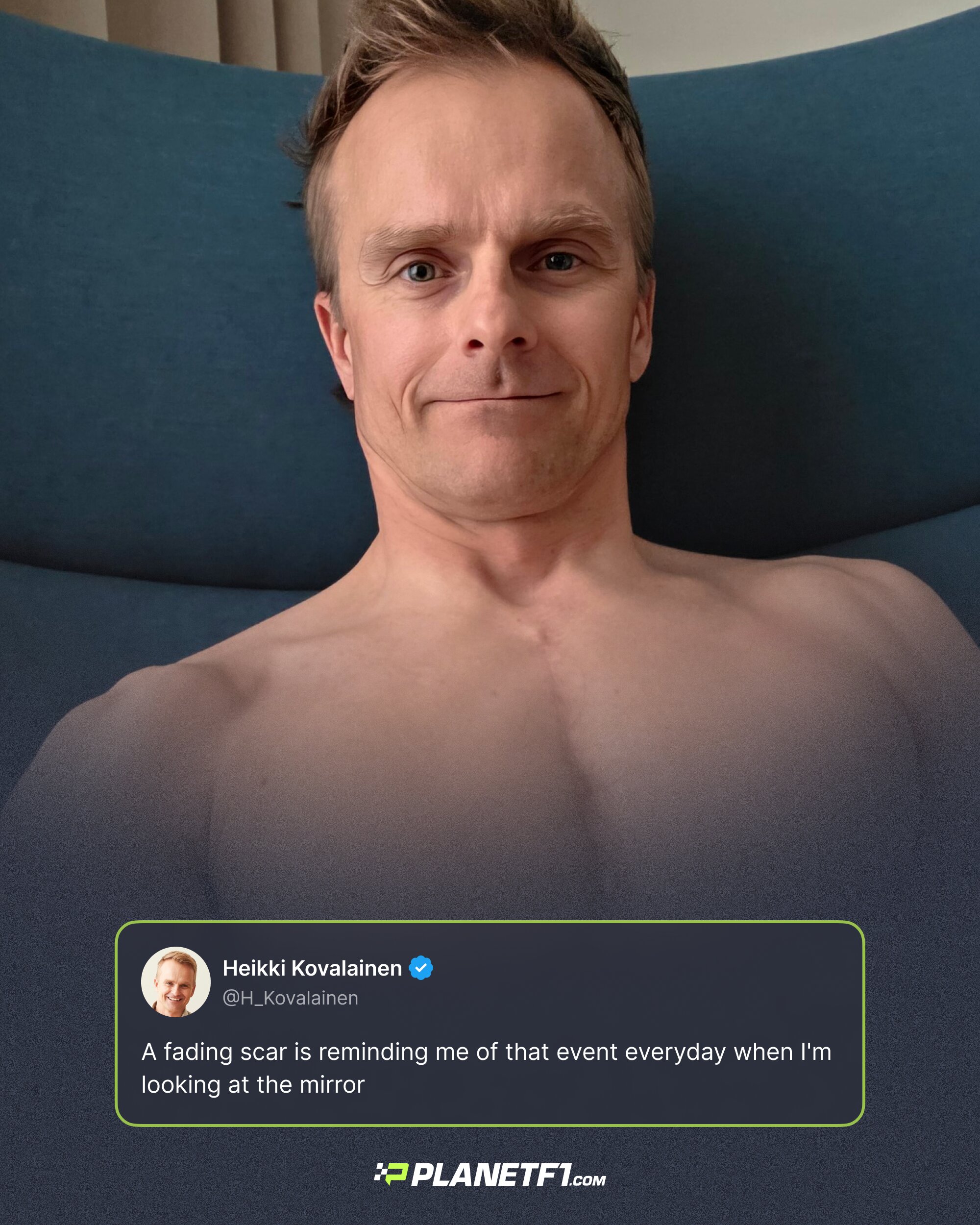 A social media post of Heikki Kovalainen topless with a scar on his chest notably improved